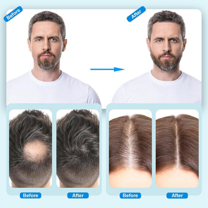 5% Minoxidil Hair Growth Serum, 60ML, for Men and Women, Hair Los